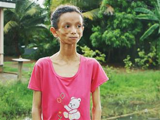 Xót cảnh thiếu nữ 16 tuổi chỉ còn da bọc xương, 3 năm trời phải tháo khớp tay chân để giành sự sống từ căn bệnh quái ác